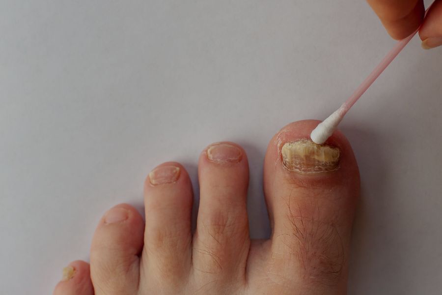 Eliminación de hongos de las uñas con láser