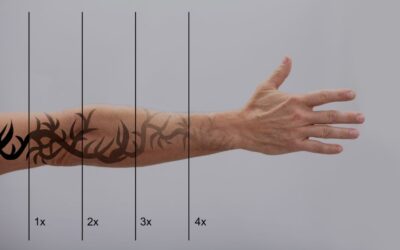 Todo lo que necesitas saber sobre la eliminación de tatuajes láser