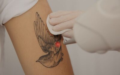 ¿Es dolorosa la eliminación de tatuajes con láser?