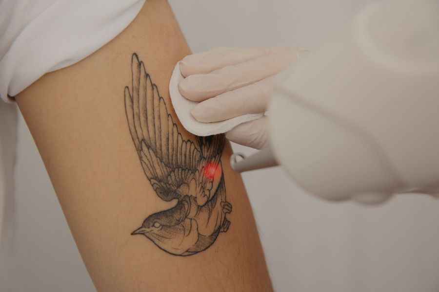 ¿Es dolorosa la eliminación de tatuajes con láser?