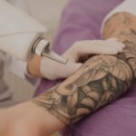Cuidados Post-Tratamiento para la Eliminación de Tatuajes con Láser