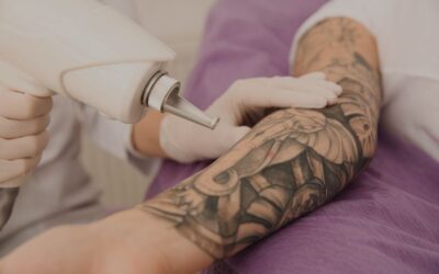 Cuidados post-tratamiento de eliminación de tatuajes