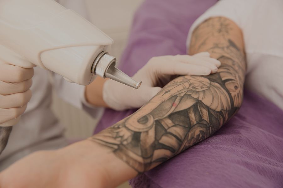 Cuidados post-tratamiento de eliminación de tatuajes