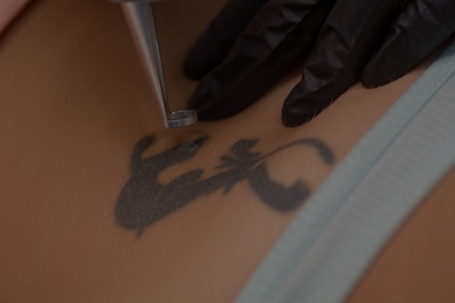 Factores que afectan la eliminación de tatuajes