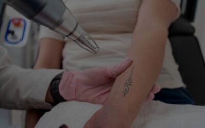 Cuidados esenciales antes y después de eliminar tu tatuaje con láser