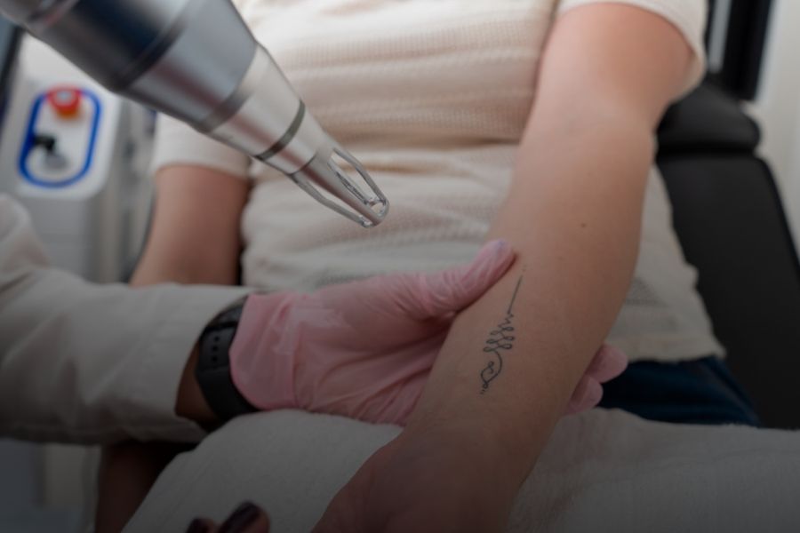 Mitos sobre la eliminación de tatuajes con láser