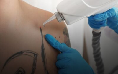 Mitos sobre la eliminación de tatuajes con láser