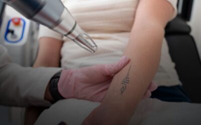 Beneficios del láser en la eliminación de tatuajes en comparación con otros métodos