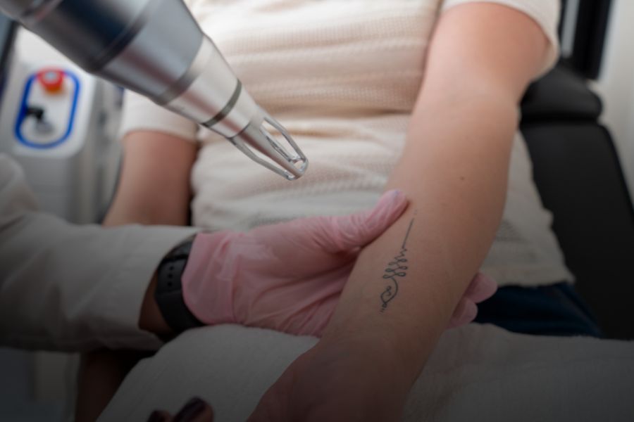 Beneficios del láser en la eliminación de tatuajes en comparación con otros métodos