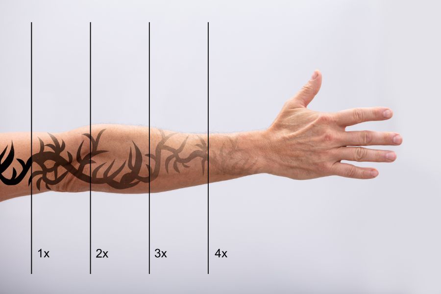 Eliminación de tatuajes y micropigmentación con láser
